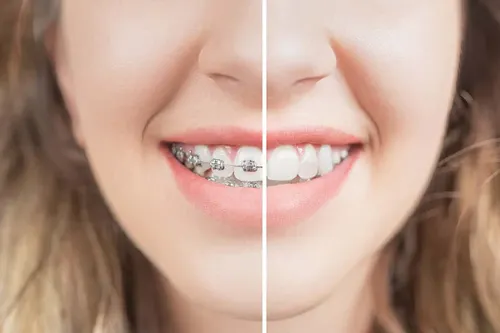 Dental braces and orthodontics treatment in Velur, Thrissur