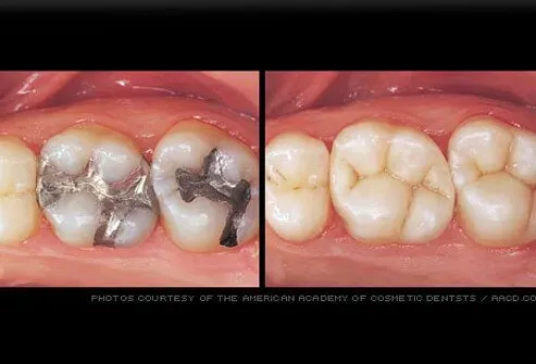 Tooth-colored cavity fillings at White Dental Care