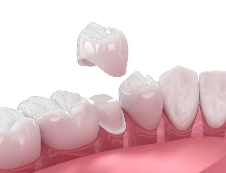 Dental crowns and bridges at White Dental Care Velur